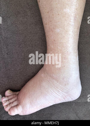 Primo piano del piede femminile malato paziente che soffre di malattia di edema Foto Stock