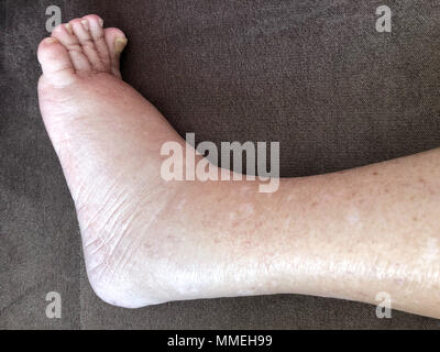 Primo piano del piede femminile malato paziente che soffre di malattia di edema Foto Stock