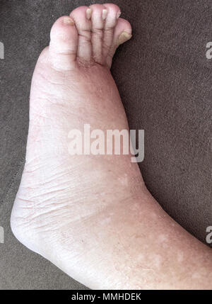 Primo piano del piede femminile malato paziente che soffre di malattia di edema Foto Stock
