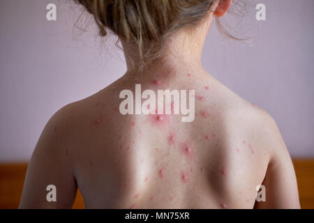 Bambina con la varicella sulla sua schiena Foto Stock