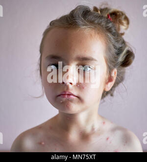 Ritratto di un grazioso 6 anni bambina con la varicella Foto Stock