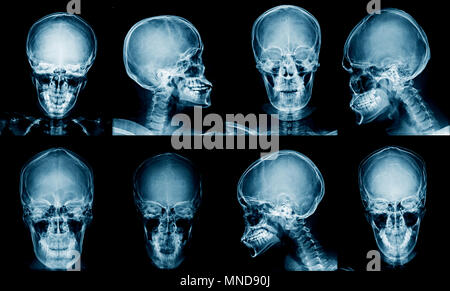 Cranio di raccolta x-ray Foto Stock