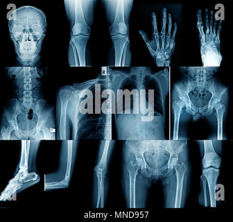 Raccolta di immagini a raggi x, cranio spalla, anca, ginocchio , la scoliosi spinne e giunto di piccole dimensioni nel contenuto Foto Stock