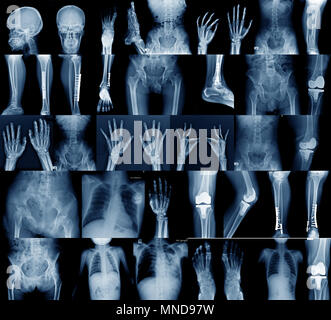 Raccolta di immagini a raggi x, cranio spalla, anca, ginocchio , la scoliosi spinne e giunto di piccole dimensioni nel contenuto Foto Stock