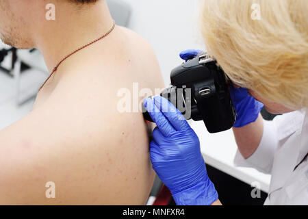 Il medico dermatologo esamina e birthmarks birthmarks del paziente con un dermatoscope Foto Stock