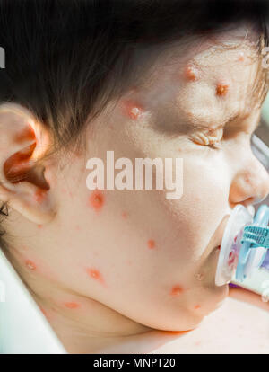 Immagine ravvicinata di virus della varicella o varicella bolla rash e blister bambinos faccia con crosta. Dermatologia concetto. Foto Stock