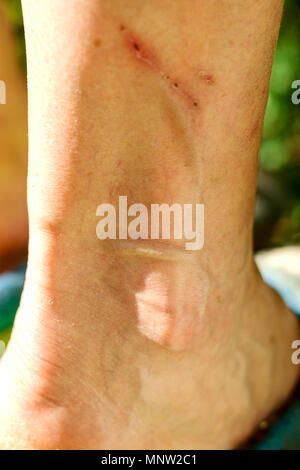 Derma colpite da vene varicose sulle gambe. Close-up. Foto Stock