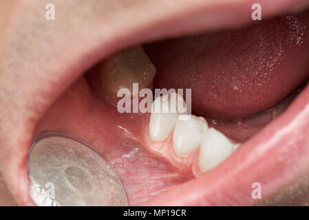 Dente divario nella bocca di uomo di close-up. Controllo medico uomo bocca Foto Stock