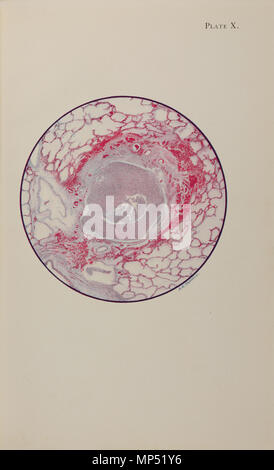 Piastra X . Inglese: piastra X da un atlante di avvelenamento del gas dalla Croce Rossa americana e la ricerca medica Comitato (croce rossa americana, 1918). Piastra titolo: 'Microscopic sezione del polmone umano dal gas mostarda, avvelenamento con la morte alla fine del secondo giorno (40 ore)." Il testo inizia: "L'bronchiole è riempito con fibrina e pus cellule, e il suo epitelio di rivestimento è stato completamente distrutto. La infiammazione ha causato un anello di caratteristica di emorragia nei tessuti attorno al tubo bronchiale, e infezione inizia a comparire negli alveoli più vicina a questi tessuti infiammati. Ma non vi è alcun ge Foto Stock