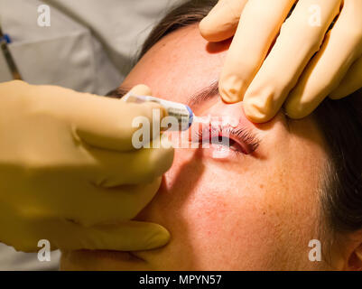 Il concetto di assistenza sanitaria - Medicina sull'occhio - Chalazion durante la visita oculistica e funzionamento - Femmina Foto Stock