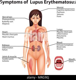 Anatomia umana i sintomi del Lupus Eritematoso Sistemico illustrazione Illustrazione Vettoriale