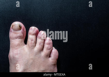 Un toenail che è stato infettato dal piede dell'atleta Foto Stock