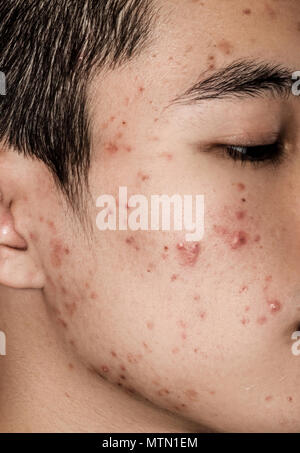 Close-up di acne sulla pelle, acne sul viso causate dagli ormoni, cicatrici, rughe e acne infiammazione sulla pelle del viso Foto Stock