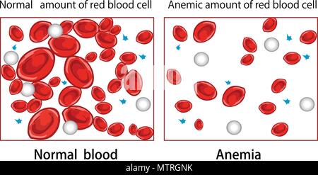 Illustrazione vettoriale di un diagramma di anemia Illustrazione Vettoriale