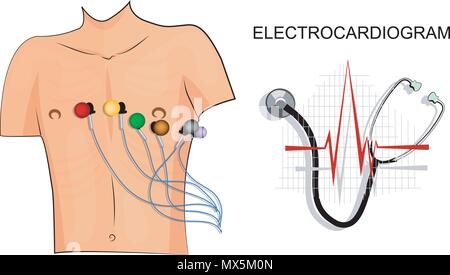 Illustrazione dell'elettrocardiogramma. Il paziente con gli elettrodi sul torace. Illustrazione Vettoriale