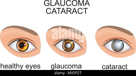 Illustrazione di un occhio sano, glaucoma, cataratta Illustrazione Vettoriale