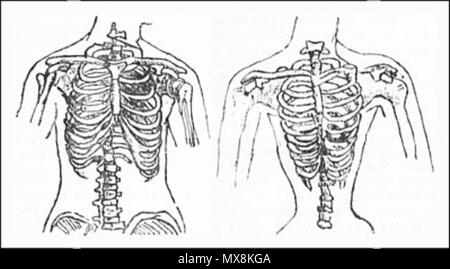 . Русский: Женская грудная клетка, изменённая после ношения корсета. 1895. Sconosciuto 205 femmina corsetto torace2 Foto Stock