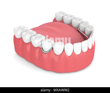 3D render di parziale rimovibile dentiera isolate su sfondo bianco Foto Stock