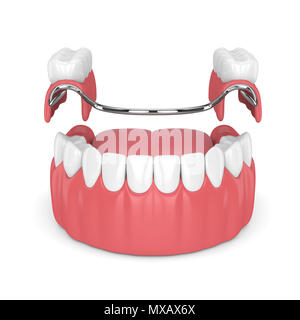 3D render di parziale rimovibile dentiera isolate su sfondo bianco Foto Stock