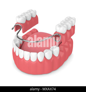 3D render di parziale rimovibile dentiera isolate su sfondo bianco Foto Stock