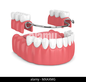 3D render di parziale rimovibile dentiera isolate su sfondo bianco Foto Stock