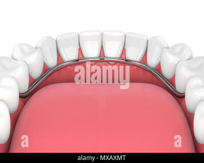 3D render di parziale rimovibile dentiera isolate su sfondo bianco Foto Stock