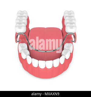 3D render di parziale rimovibile dentiera isolate su sfondo bianco Foto Stock