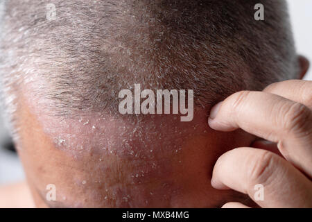 Gli uomini sono utilizzando le mani a graffiare la testa delle ulcere. Le malattie causate da anomalie della linfa. La psoriasi è una malattia della pelle. Selezionare focus shallow d Foto Stock