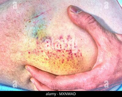 Grande e colorata livido sul corpo umano. Hurt doloroso luogo dopo incidente sportivo. Dettaglio del corpo maschio. Dolorosa per via sottocutanea il pregiudizio sulla pelle umana Foto Stock