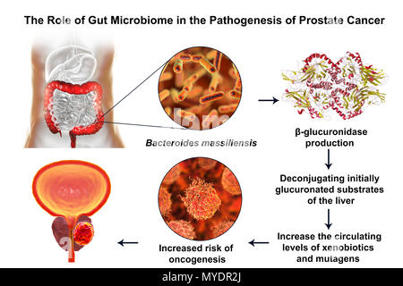 Gut microbiome e cancro della prostata. Illustrazione concettuale che illustra l'associazione dei Bacteroides massiliensis batteri nell'intestino crasso allo sviluppo del cancro prostatico.