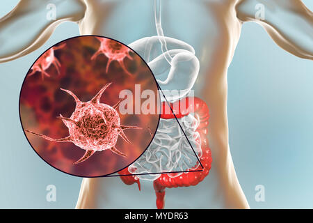 Computer illustrazione astratta di microorganismi patogeni umani nel grande intestino. Foto Stock