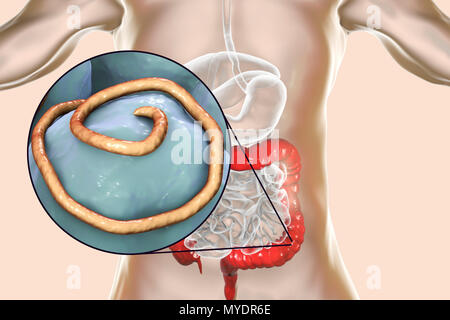 Threadworm infezione. Computer illustrazione che mostra più trichine (Enterobius sp.) nell'intestino umano. Trichine sono nematodi che parasitize l'intestino crasso e intestino cieco di molti animali. Negli esseri umani sono cause comuni di infezione enterobiasis. Nematodi sono non segmentata di worm che può essere parassita o libero-vivente a seconda della specie. Foto Stock