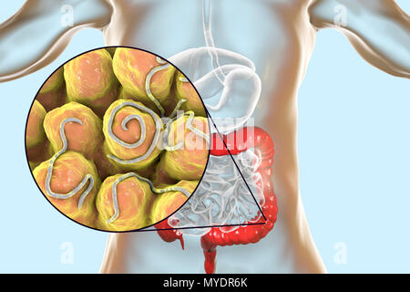 Threadworm infezione. Computer illustrazione che mostra più trichine (Enterobius sp.) nell'intestino umano. Trichine sono nematodi che parasitize l'intestino crasso e intestino cieco di molti animali. Negli esseri umani sono cause comuni di infezione enterobiasis. Nematodi sono non segmentata di worm che può essere parassita o libero-vivente a seconda della specie. Foto Stock