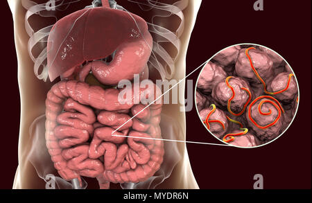 Threadworm infezione. Computer illustrazione che mostra più trichine (Enterobius sp.) nell'intestino umano. Trichine sono nematodi che parasitize l'intestino crasso e intestino cieco di molti animali. Negli esseri umani sono cause comuni di infezione enterobiasis. Nematodi sono non segmentata di worm che può essere parassita o libero-vivente a seconda della specie. Foto Stock