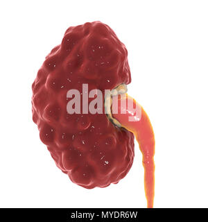 Pielonefrite cronica, illustrazione del computer. Il rene interessato ha un irregolare graffiato la superficie corticale, dilatate e smussati calyces (giallo), e di un uretere dilatato. Foto Stock