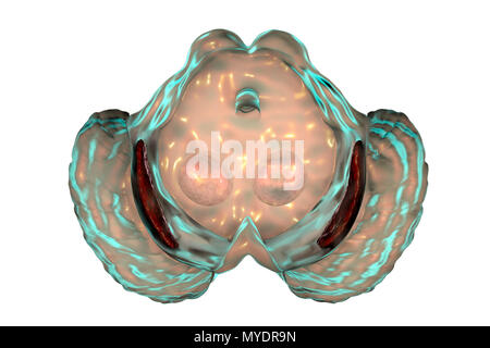 Substantia nigra. Computer illustrazione che mostra un degenerato substantia nigra nella malattia di Parkinson. La substantia nigra svolge un ruolo importante nella ricompensa, tossicodipendenza, e movimento. La degenerazione di questa struttura è una caratteristica del morbo di Parkinson. Foto Stock