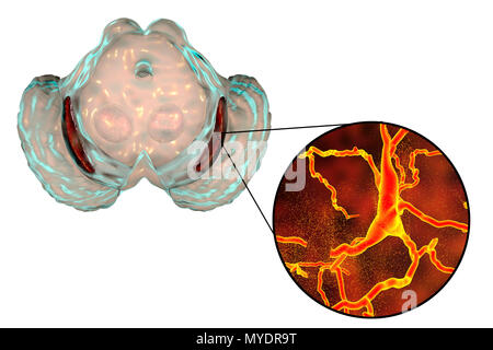 Substantia nigra. Computer illustrazione che mostra un degenerato substantia nigra e dei neuroni dopaminergici nella malattia di Parkinson. La substantia nigra svolge un ruolo importante nella ricompensa, tossicodipendenza, e movimento. La degenerazione di questa struttura è una caratteristica del morbo di Parkinson. Foto Stock