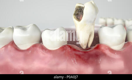 La carie in tre fasi - Fase 3 l'estrazione del dente - 3D Rendering Foto Stock