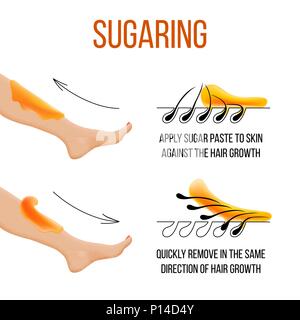 Depilazione e zuccheraggio. La rimozione dei peli. follicolo. Donna gamba con zucchero o cera. Prima e dopo. Processo e fasi di depilazione. illustrazione vettoriale Illustrazione Vettoriale