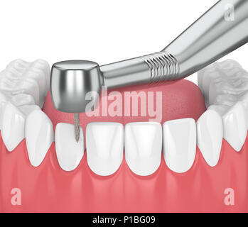 3D render di ganasce con dispositivo dentistico a mano e trapanare isolato su bianco Foto Stock