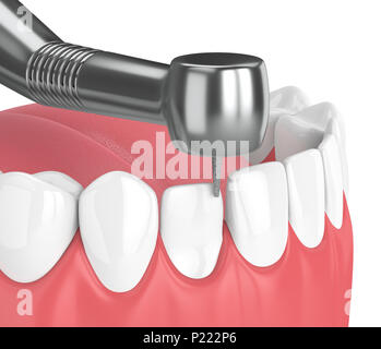 3D render di ganasce con dispositivo dentistico a mano e trapanare isolato su bianco Foto Stock