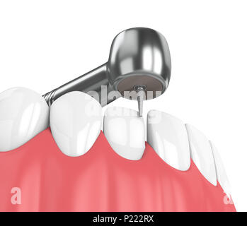 3D render di ganasce con dispositivo dentistico a mano e trapanare isolato su bianco Foto Stock