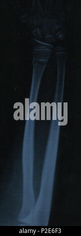 . Raggio fratturato con circa 10o angolazione laterale. Il soggetto era 11yr old maschio. 8 aprile 2004. WA Reparto di Salute - ospedale pubblico paziente 44 raggio 10deg pausa laterale 02 gnangarra Foto Stock