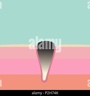 Illustrazione Vettoriale della struttura blackhead schema - strati di pelle lato tagliato e anatomia di un intasamento dei pori con blackhead batteriche acne. Illustrazione Vettoriale