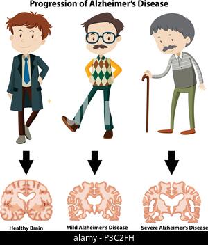 Una progressione della malattia di Alzheimer illustrazione Illustrazione Vettoriale