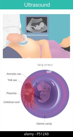 Bambino a ultrasuoni. Uso di onde acustiche per visualizzare l'embrione nella cavità uterina. Illustrazione Vettoriale