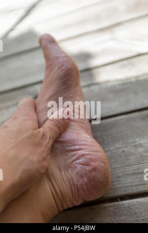 Vista ravvicinata di uomo adulto il male del piede atleta asciutto e tallone incrinato Foto Stock