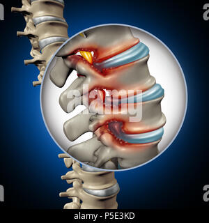 La stenosi spinale concetto medico come una malattia degenerativa nelle vertebre umane causando la colonna vertebrale compressa nervi corpo umano malattia. Foto Stock