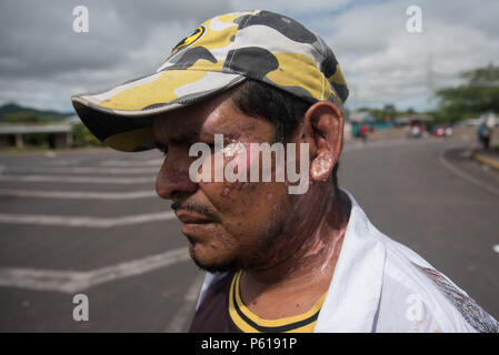 27 giugno 2018, Nicaragua, Chontales: un uomo mostra bruciature causate durante gli scontri con una barricata. I cittadini e i lavoratori agricoli bloccato una strada di campagna da Managua a chontales. I blocchi sono parte delle proteste contro il governo di Daniel Ortega. La situazione in Nicaragua non ha calmata dalla metà di aprile. L'autoritario Presidente Ortega ha voluto spingere attraverso una riforma sociale, ma il pubblico in generale contrari. Fin dal momento in cui le masse sono state per le strade chiedendo le dimissioni del presidente e di sua moglie, Vice Presidente Murillo. Foto: Carlos Herrera/dpa Foto Stock