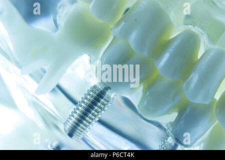 Titanio dentale ortodontico estetico impianto di dente in bocca dentisti denti modello closeup isolato. Foto Stock